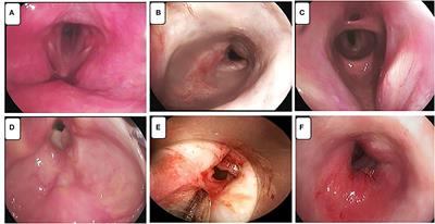 Case Report: Laryngotracheal Post-Intubation/Tracheostomy Stenosis in COVID-19 Patients